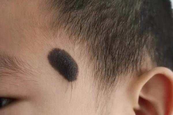 脸上各部位的胎记算命 脸上各部位的胎记算命